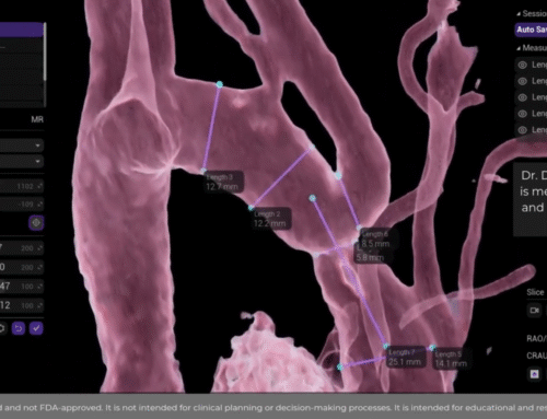 CoA (Aortic coarctation) stent simulation (MR)