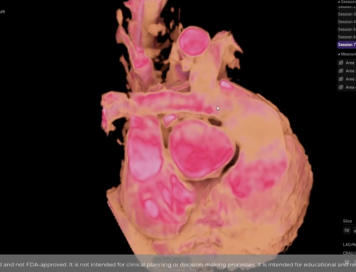PPVI (Pulmonary Valve Implantation) Venus P simulation