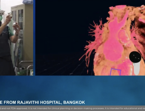 PPVI (Pulmonary Valve Implantation) live case simulation on CSI Congress, Bangkok