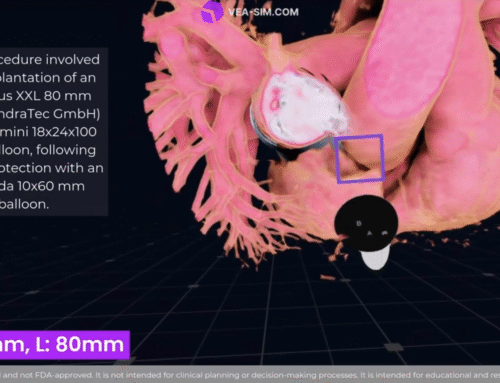 SVD (Sinus Venosus Defect) stent simulation