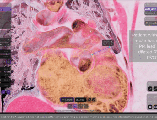 TPVI (Transcatheter Pulmonary Valve Implantation) simulation