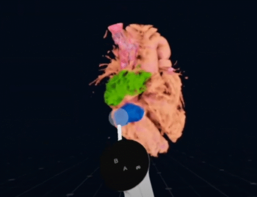 Ventricular Inversion, DORV (Double Outlet Right Ventricle) baffle simulation by Dr. Thomas Matthew