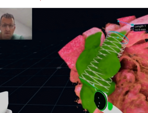 PPVI (Pulmonary Valve Implantation) live commentary by Dr. Ali Houeijeh