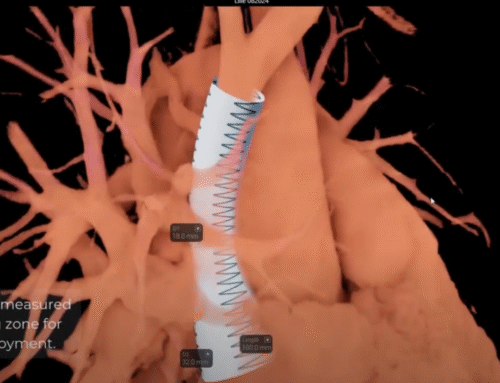 SVD (Sinus Venosus Defect) stent simulation by Dr. Ali Houeijeh