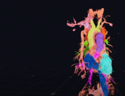 TASVC (Total anomalous systemic venous connection), DORV baffle simulation by Dr. Thomas Matthew