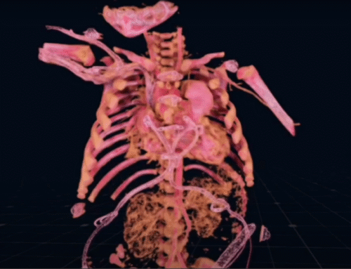 Complex DORV with Remote VSD & Arch Hypoplasia. Baffle simulation by Dr. Thomas Matthew